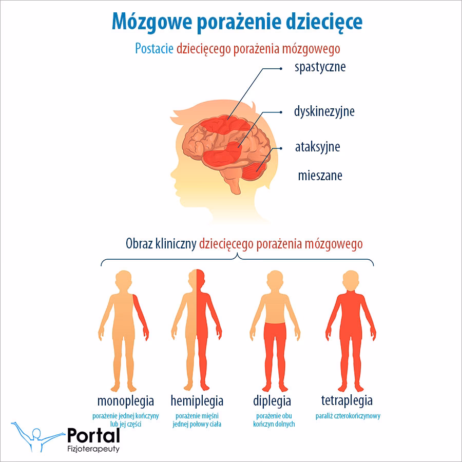 Czym jest edukacja konduktywna w przypadku porażenia mózgowego?