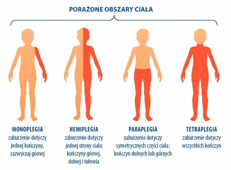 Czym jest edukacja konduktywna w przypadku porażenia mózgowego?