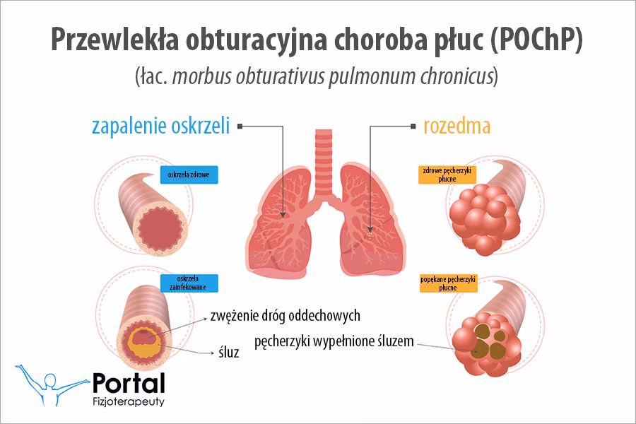 Jakie są najnowsze metody leczenia POChP?